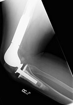 Lower limb salvage prosthesis